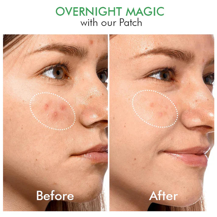 Hydrokoloidní náplasti na akné Clear Overnight Patches