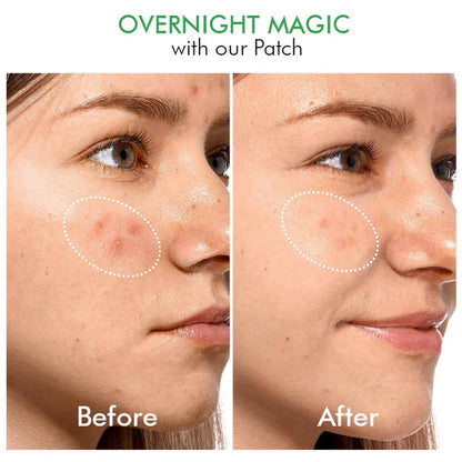 Hydrokoloidní náplasti na akné Clear Overnight Patches
